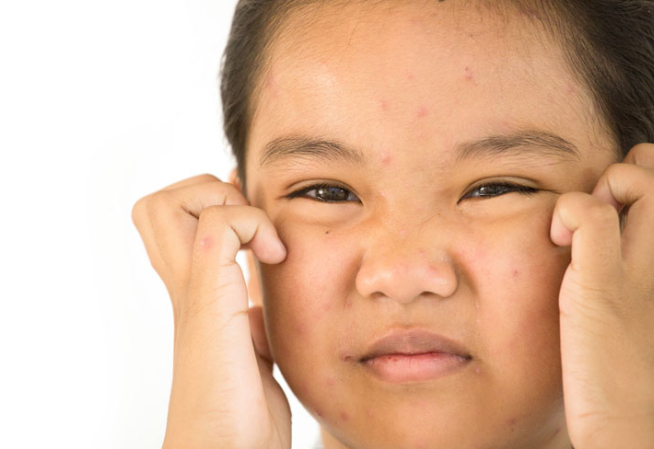 Fille avec des boutons sur le visage 